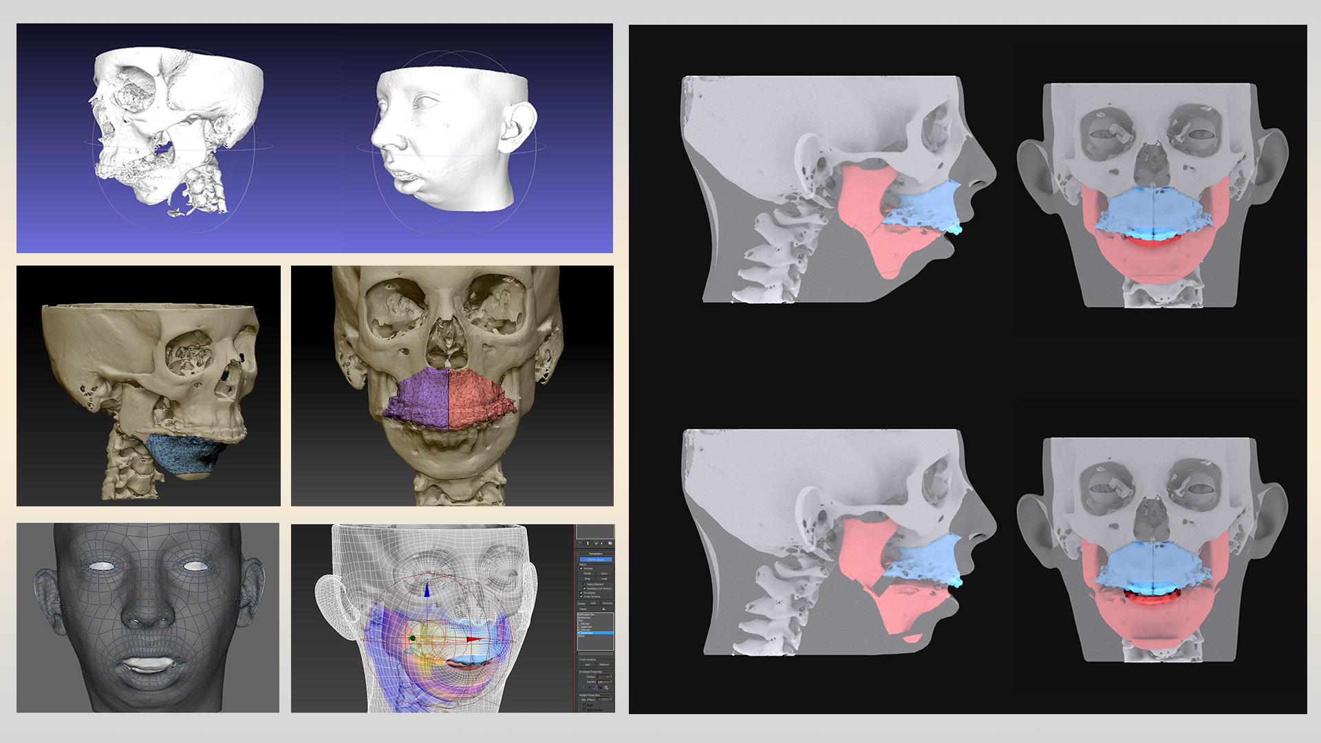 Surgical Planning for Dentistry Digital Manipulation of the Jaw ⋆ X